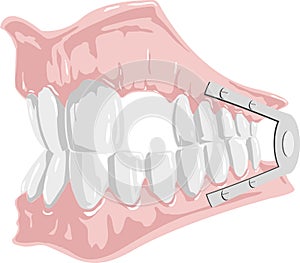 Dental prosthesis