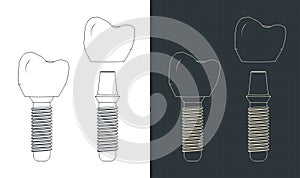 Dental prosthesis blueprints