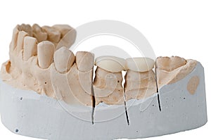 Dental Prosthesis - Filling