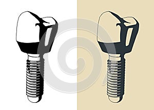 Dental prosthesis illustrations