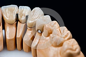 Dental prosthesis model with implanted teeth