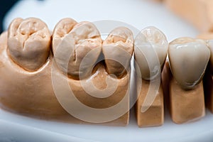 Dental prosthesis model for teeth