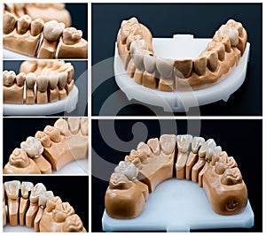 Dental prosthesis models collage