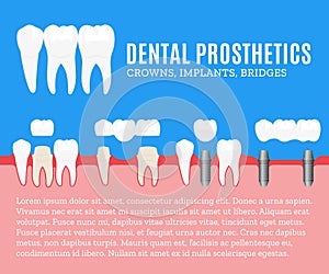 Dental prosthetics illustration