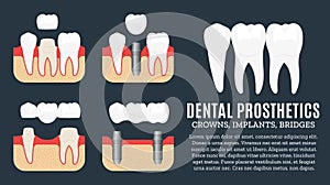 Dental prosthetics illustration