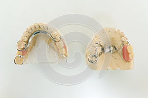 Dental prosthetics, implants. Gypsum model on the table at the dentist