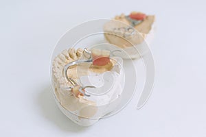 Dental prosthetics, implants. Gypsum model on the table at the dentist