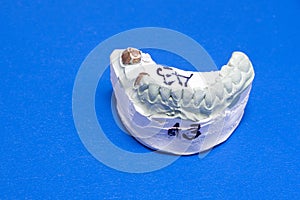 Dental prothetic photo