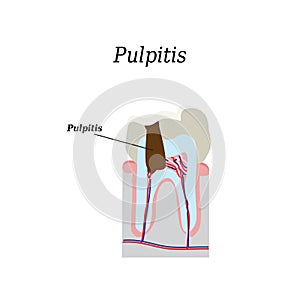 Dental pulp. Vector illustration on