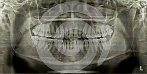 Dental Radiograph X-Ray photo