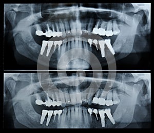 Dental radiography photo