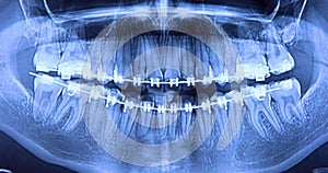 Dental radiography with braces