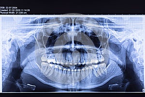 Dental radiography with braces