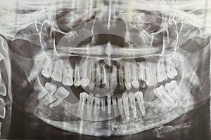 Dental radiography. Digital x-ray teeth scan of adult female.