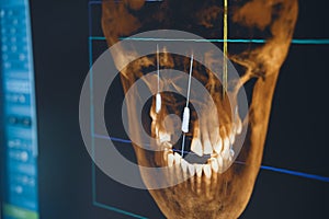 Dental radiography x-ray on digital screen in dental clinic