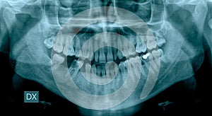 Dental X-Ray