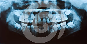 Dental X-Ray