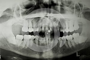 Dental X Ray