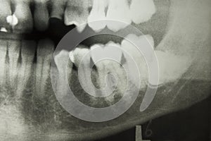 Dental X Ray