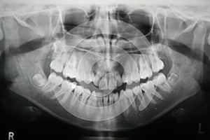 Dental X-ray