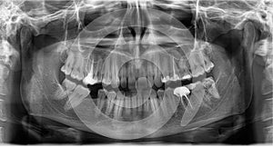 Dental X-Ray