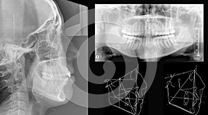 Dental X-Ray