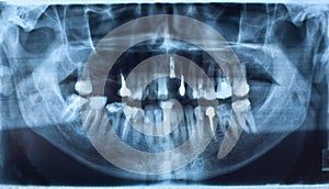 Dental X-Ray