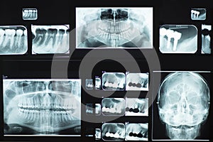 Dental X-Ray