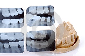 Dental X-Ray And Casting