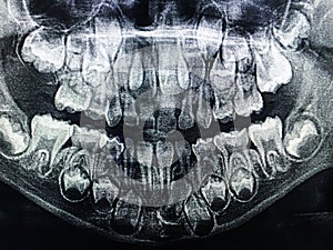 Dental X-Ray of child 6 years, all baby teeth in view.