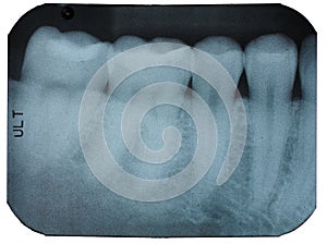 Dental x-ray film showing teeth