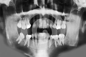 Dental X-Ray - Full Mouth Scan