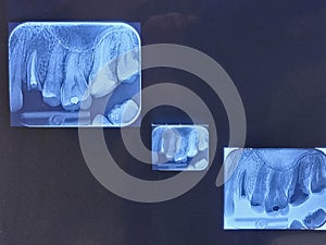 Dental x-ray image, teeth x-ray film