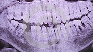 Dental X-Ray of the Jaw with Teeth against the Light. Sealed Molars. Radiography