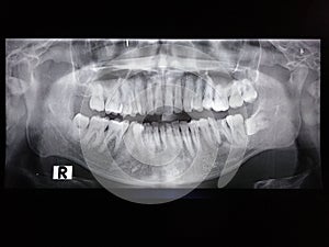 Dental X-Ray Panoramic Rontgen Of Wisdom Teeth