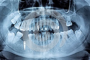 Dental x-ray with periodontitis problems, decayed teeth and implant