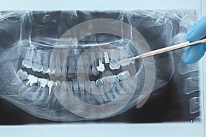 Dental X-ray. Radiography