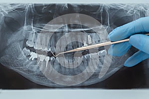 Dental X-ray. Radiography