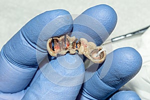 Dental restoration of rotten roots of the teeth with ceramic crowns. cast posts dentistry
