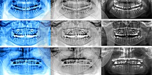 Dental scan , types of fixed appliances