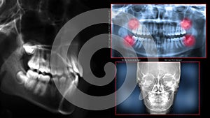 Dental scan x-ray teeth photo