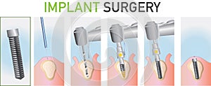 Dental surgery illustration