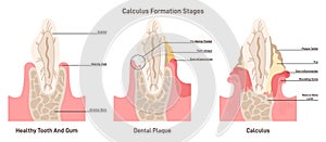 Dental tartar or calculus formation stages. Dental plaque disease