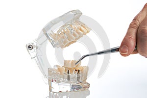 Dental technician placing the fixed partial denture