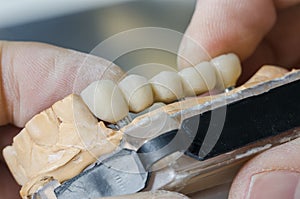 Dental technician placing the fixed partial denture.