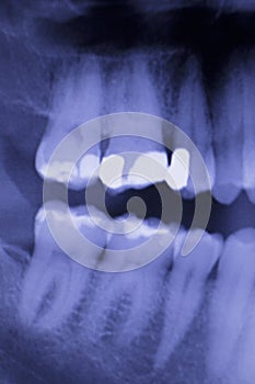 Dental teeth filling dentists xray scan