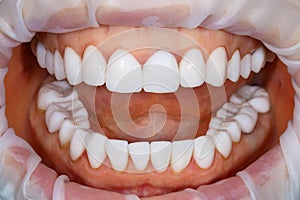 Dental of teeth after treatment. Photo of teeth close up. Teeth whitening image. Treatment plan for new smile. Making bleach