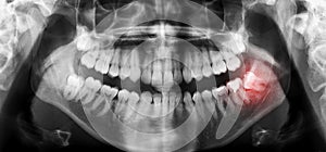 Dental teeth x-ray panoramic scan with skewed wisdom tooth photo