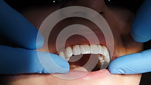 Dental and teethcare care concept. process of installing veneers. Veneers setting in modern dentistry. Close-up shot of