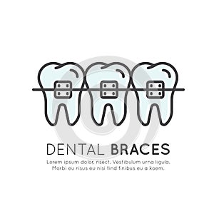 Dental Tooth Braces Installation Process, Aesthetics, Orthodontist